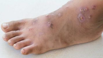 Infekční inemocnění impetigo