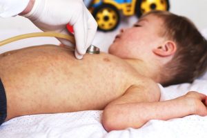 Spalničky očkování vakcína