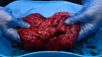 Placenta po porodu