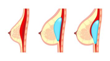 Kojení s prsními implantáty
