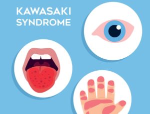 Kawasakiho syndrom