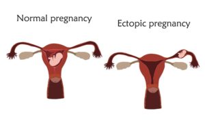 Příznaky mimoděložního těhotenství