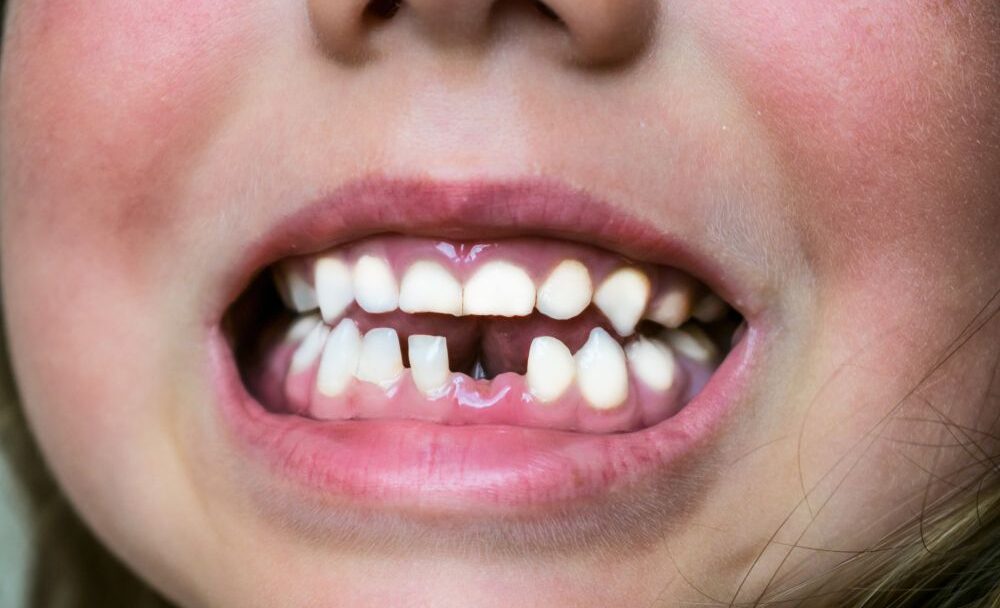 Co dělat, když si dítě vyrazí zub